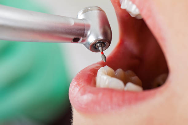 Best Emergency Dentist for Knocked-Out Tooth in Cleveland, OK